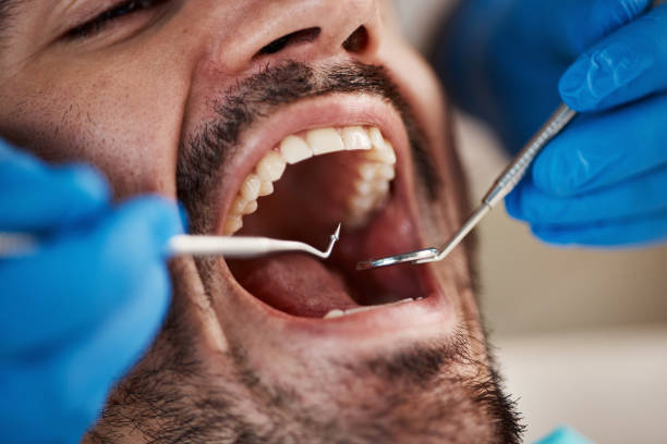 Best Dentist for Tooth Abscess  in Walce, LA